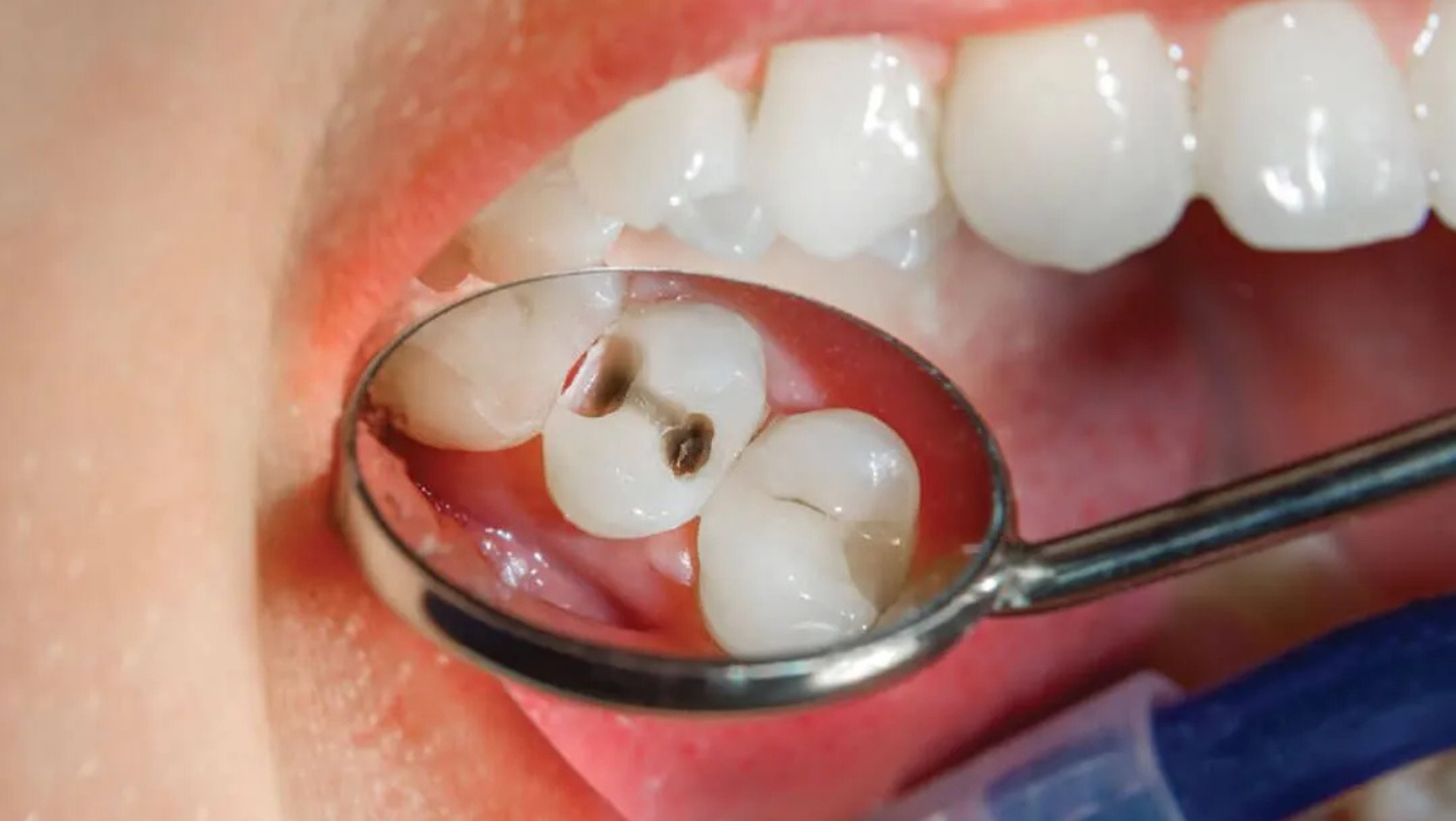 teethfilling_1 teethfilling_1