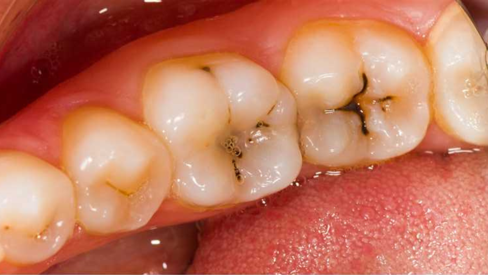 teethfilling_3 teethfilling_3